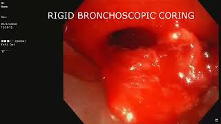 Central Airway Tumor  Rigid Bronchoscopy Tumor Debulking  Snaring  Cryoextraction [upl. by Bergeron]