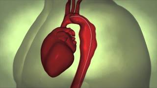 Thoracic Aortic Aneurysm [upl. by Estas739]