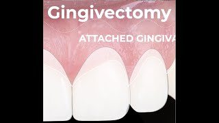 Esthetic Gingival Recontouring after Orthodontic Treatment [upl. by Acenahs597]