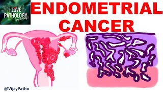 ENDOMETRIAL CARCINOMA Risk factors Etiopathogenesis Morphology amp Clinical features [upl. by Gerry]