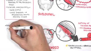 Intracranial Haemorrhage Types signs and symptoms [upl. by Sib659]