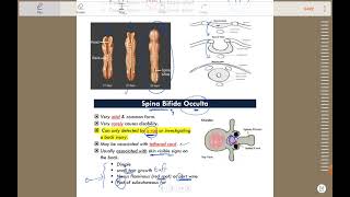 Neurosurgery  Neural tube defect [upl. by Akeim]