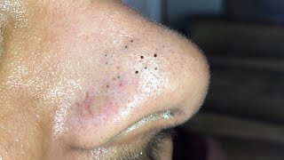 Blackhead SPA reddit skincare popping blackheads pimples medication [upl. by Zarger]