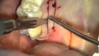 Periodontal Microsurgery Gingival Grafting [upl. by Marriott952]