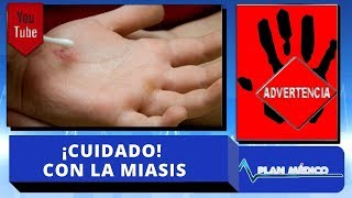 ¡Cuidado Si te salen gusanos de la piel tienes Miasis  Plan Medico [upl. by Goar]