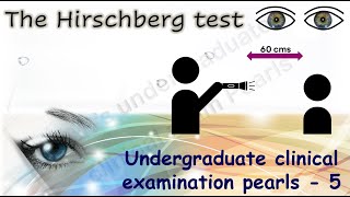 The Hirschberg Test  Undergraduate clinical examination pearls  5 [upl. by Osnofedli]