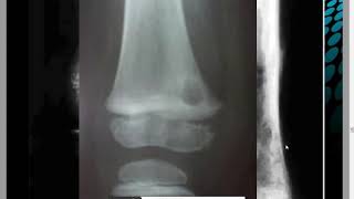 OSTEOMYELITE AIGUE DE LENFANT Dr M DJELAD [upl. by Pennie]