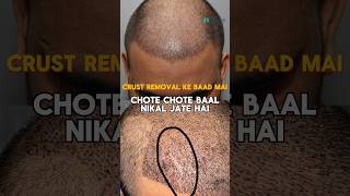 Losing hair during crust removal after hair transplant Is it Normal  Explained by Dr Jangid [upl. by Tiernan977]