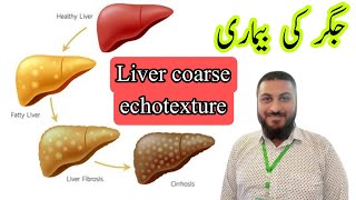 Coarse echotexture liver  chronic liver disease  hepatitis fatty liver [upl. by Bay]