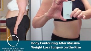 Body Contouring After Massive Weight Loss Surgery on the Rise [upl. by Hamo]