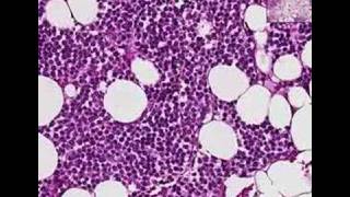 Histopathology BoneMultiple myeloma [upl. by Assenna]