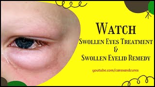 Swollen Eyes Treatment  Puffy Eyelid  How To Treat A Swollen Eye  Swollen Eyelid Remedy [upl. by Clorinde921]