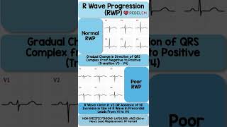 Normal vs Poor R Wave Progression RWP REBELEM ECG EKG RWaveProgression MedEd [upl. by Ardnama]