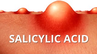 Heres WHY Salicylic Acid is Best For ACNE [upl. by Ainsley153]