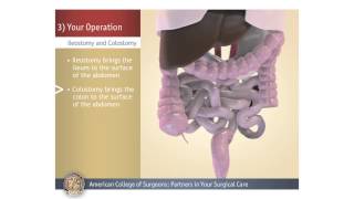 ColostomyIleostomy Your Operation [upl. by Saixela]