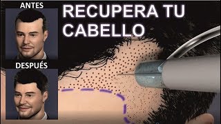 IMPLANTE o INJERTO de CABELLO 💕🙆 para MUJERES Y HOMBRES  Todas las RESPUESTAS  DR ALBERTO CALVO [upl. by Codding]