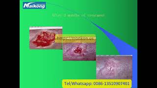 MAIKONG Diabetic Foot Capillaries Therapy SystemPDN [upl. by Garibald]