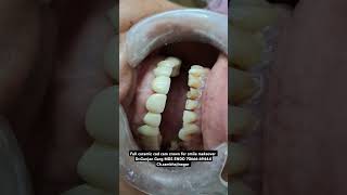 Full ceramic crown in Aurangabad zirconia crown in Aurangabad digital crown cad cam cap in Aurangaba [upl. by Sergius]