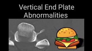 Vertibral end plates abnormalities on lumbosacral spine x rays and CT images [upl. by Oiramrej]