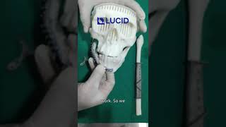 Guided Mandible Resection amp Reconstruction using Fibula Free Flap amp CustomMade Titanium Implant [upl. by Carmon]