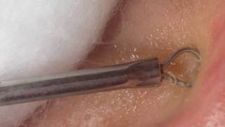 Blackheads and Whiteheads Removal Using Comedone Extractor Tool Beauty Salon Stella Part 13 [upl. by Dan]