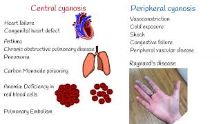 Cyanosis Symptoms and Causes Central and Peripheral Cyanosis [upl. by Eniahpets846]