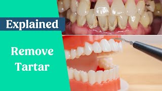 How to remove tartar from teeth without a dentist [upl. by Giulio273]