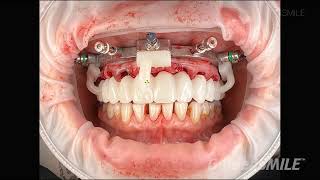 GuidedSMILE Dentate Natural Single Maxillary  Dr Agahi [upl. by Body63]