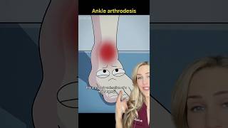 Doctor explains ankle fusion surgery [upl. by Amando392]