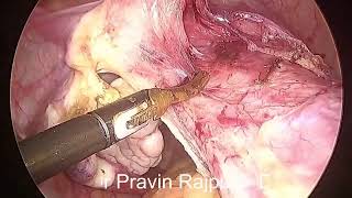 Total laparoscopic hysterectomy TLH [upl. by Naltiak]