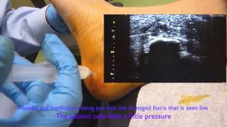 Ultrasound Guided Plantar Fascia Injection [upl. by Gilbert374]