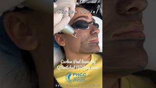 Carbon Laser Facial getsmarthairclub skintreatment shorts shortvideo shortsfeed [upl. by Lloyd]