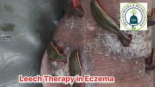 Leech Therapy in Eczema at Difa Ayurveda and Hijama Center Agra [upl. by Weisman898]