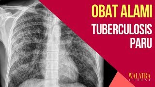 Obat TUBERCULOSIS PARU Herbal  Ekstrak Teripang Emas QNC Jelly Gamat [upl. by Rosabel272]