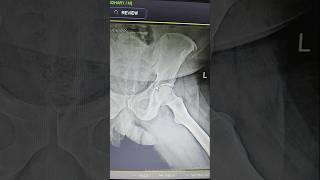 Fracture of ilium bone hip jointparamedicalclasses anatomy [upl. by Ssepmet]