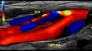 Carotid Artery Dissection Ultrasound [upl. by Jeanine153]