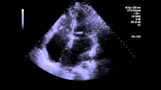 CIA Ecocardiograma tridimensional Siemens SC2000 [upl. by Ahsinel180]