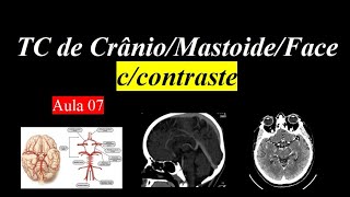 Curso de Tomografia ccontraste  Aula 7 CrânioMastoideFace [upl. by Bbor]