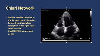 Normal Right Atrial Variants [upl. by Wurster]