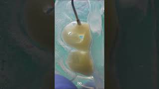 Composite veneers veneers bonding dentistry [upl. by Llerut]