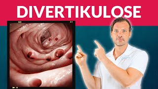 Divertikulose vermeiden Entzündung Divertikulitis muss nicht sein [upl. by Oiramad]