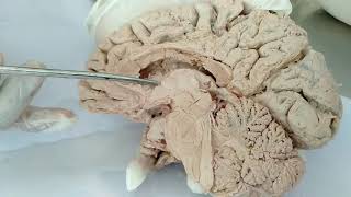 Lateral ventricle of BrainNeuroanatomy [upl. by Ayotna]