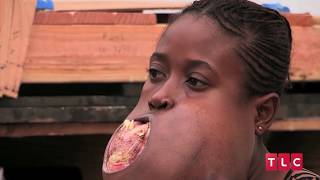 Girl Has FootballSized Tumour On Her Face Body Bizarre Episode 6 [upl. by Amrak]