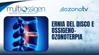 Ozono TV  Ernia del disco [upl. by Thamora]