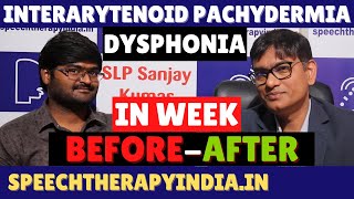 BeforeAfter Dysphonia  Interarytenoid Pachydermia Sulcus Vocalis Within A Week  SLPSanjayKumar [upl. by Desdamonna]