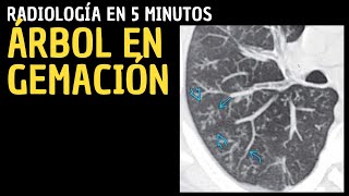 Radiología en 5 minutos Signos radiológicos pulmonares Árbol en gemación [upl. by Romulus]