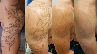 Eliminar tatuajes con láser Antes y después  Borratatu Barcelona [upl. by Derward]