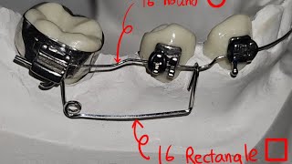 uprighting spring to upright mandibular molar [upl. by Auqinehs]