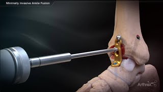 Minimally Invasive Ankle Fusion [upl. by Dnyletak]