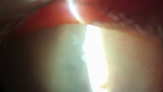 Slit lamp examination of a pseudophakic patient with glaucoma and a bleb from a trabeculectomy [upl. by Pinkerton]